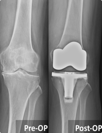 Joint Replacement